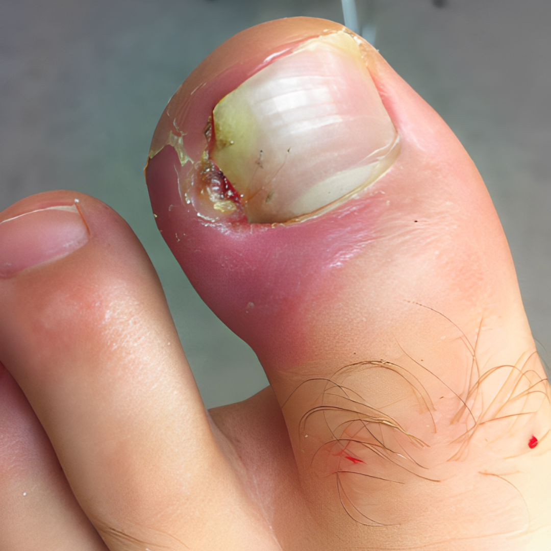  Infection around toenail