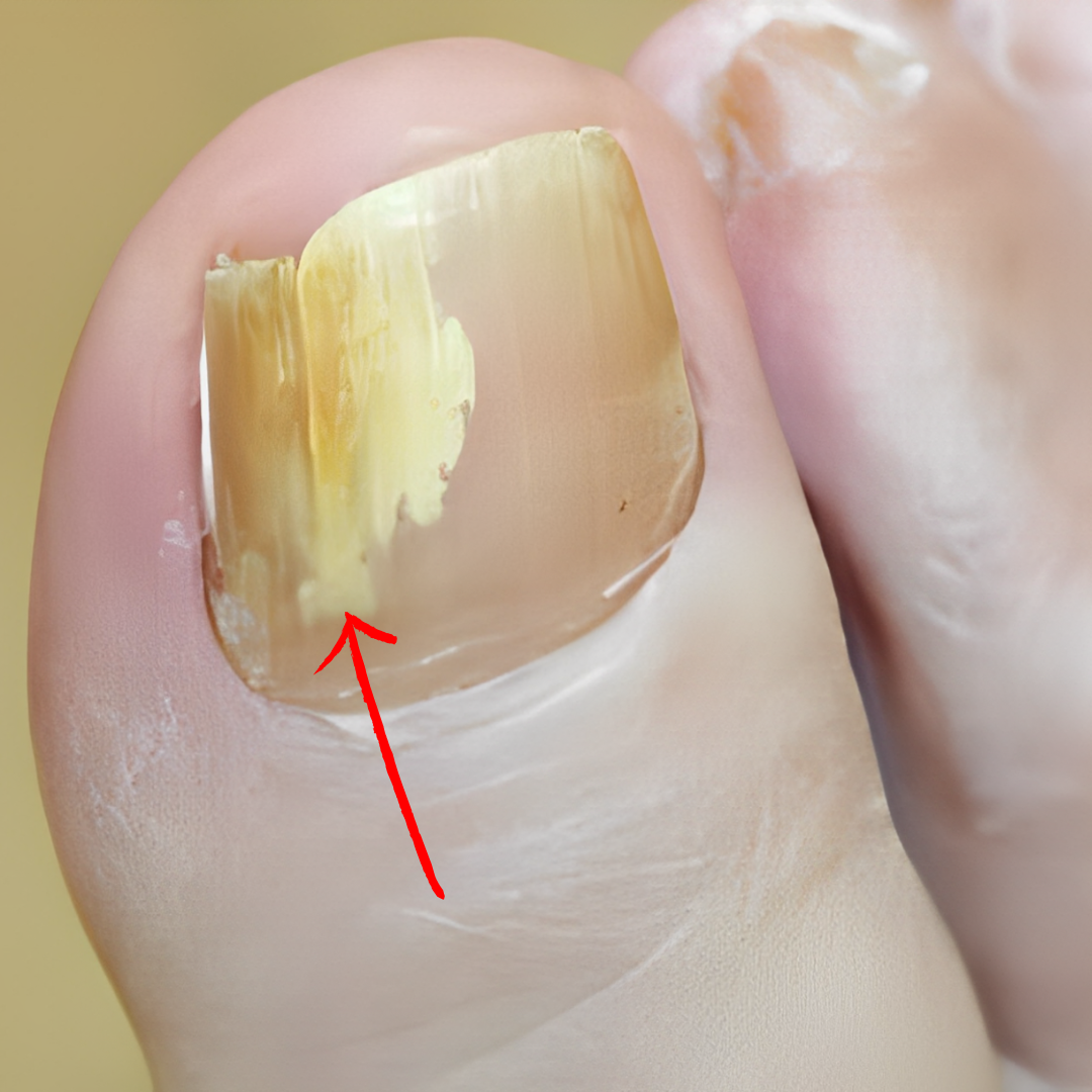Infection under toenail 