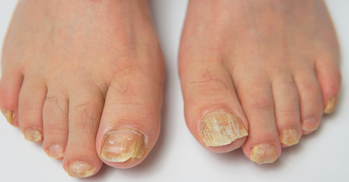 What Can You Do About Toenails That Are Yellowish? – Toenail Fungus ...